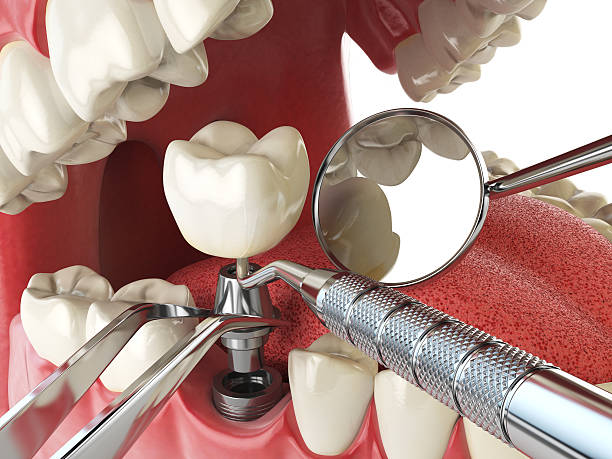 Best Emergency Treatment for Dental Infections or Abscesses in Marion, MS